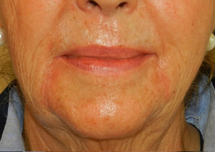A very satisfied customer. After wrinkler filler, her wrinkles are less visible and looks happier