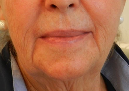 a customer from Marbella would like to do something about het wrinkles at the corner of her mouth