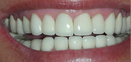 After treatment she now has bright shining teeth in a healthy mouth