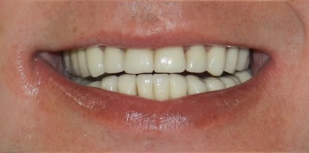 After treatment by the dentist at Clinica Dental Soriano, Marbella
