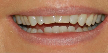 Teeth before treatment at Clinica Dental Soriano