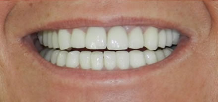 Na een bezoek aan Clinica Dental Soriano een gezonden en schitterende mond met 30 kronen 