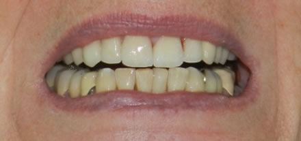 After treatment by the dentist at Clinica Dental Soriano, Marbella