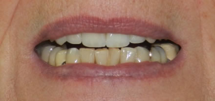 Before treatment by the dentist at Clinica Dental Soriano, Marbella