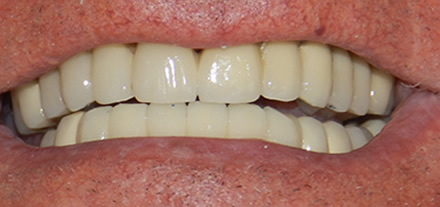 After treatment by the dentist at Clinica Dental Soriano, Marbella