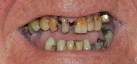 Before treatment by the dentist at Clinica Dental Soriano, Marbella