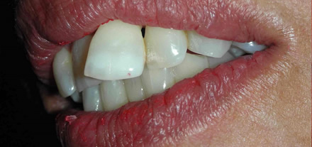 Mond voor plaatsen van een 3- delig brug door Clinica Dental Soriano