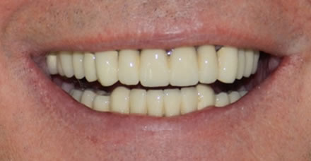 a very happy customer after placing 32 crowns her at Clinica Dental Soriano) 