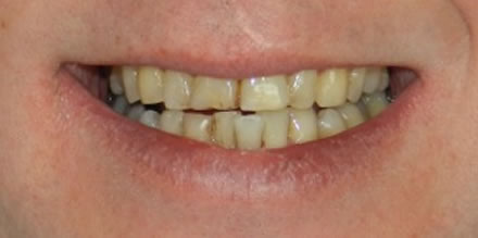 Before treatment by the dentist at Clinica Dental Soriano, Marbella