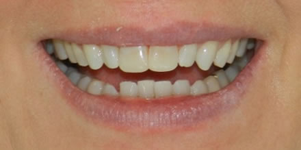 Teeth before treatment at Clinica Dental Soriano