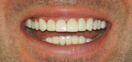 Na behandeling bij tandarts Clininca Dental uit Marbella