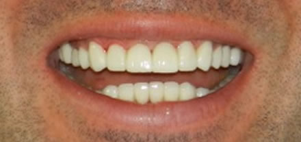 After treatment by the dentist at Clinica Dental Soriano, Marbella