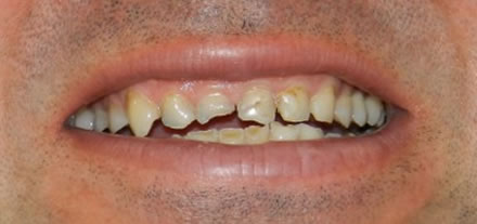 voor behandeling bij tandarts Clininca Dental uit Marbella