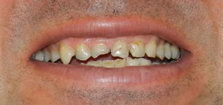 Before treatment by the dentist at Clinica Dental Soriano, Marbella