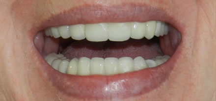 After placing 3 bridges by dentist CDS Marbella