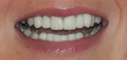 After treatment by the dentist at Clinica Dental Soriano, Marbella