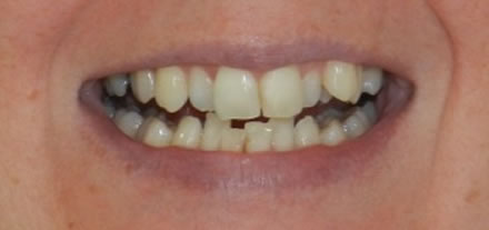 Before treatment by the dentist at Clinica Dental Soriano, Marbella