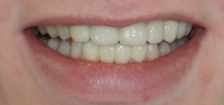 After treatment by the dentist at Clinica Dental Soriano, Marbella