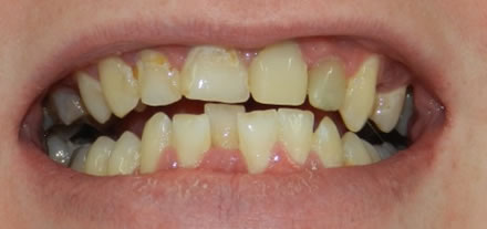 Before treatment by the dentist at Clinica Dental Soriano, Marbella