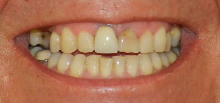 a customer from the center of Marbella would like to have a sparkling smile